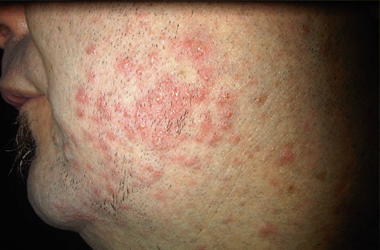 Skin Condition Exposed and Treated by L J Health Wellness Centre Nerang